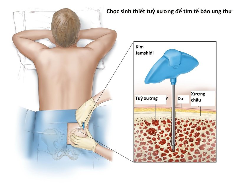 Sinh thiết tủy xương thường gây đau nhức cho người bệnh
