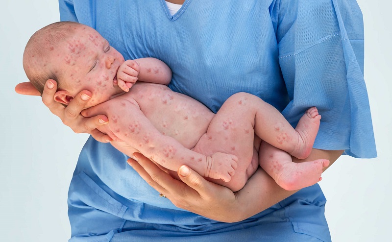 Tình trạng phát ban nhiễm trùng thường phổ biến ở trẻ từ 6 tháng đến 2 tuổi 