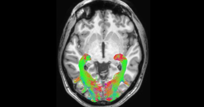 Chụp MRI giúp bạn phát hiện những tổn thương ở não bộ