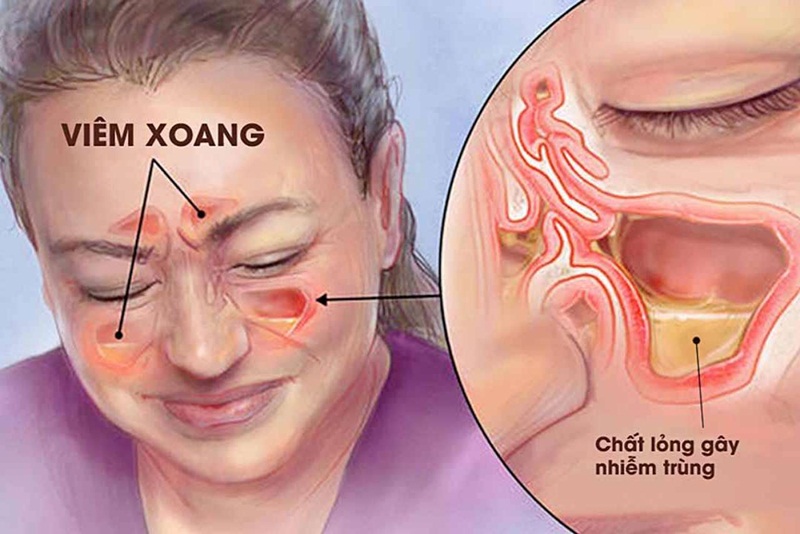 Hiện tượng dịch đờm chảy từ mũi xuống họng có thể là do viêm xoang