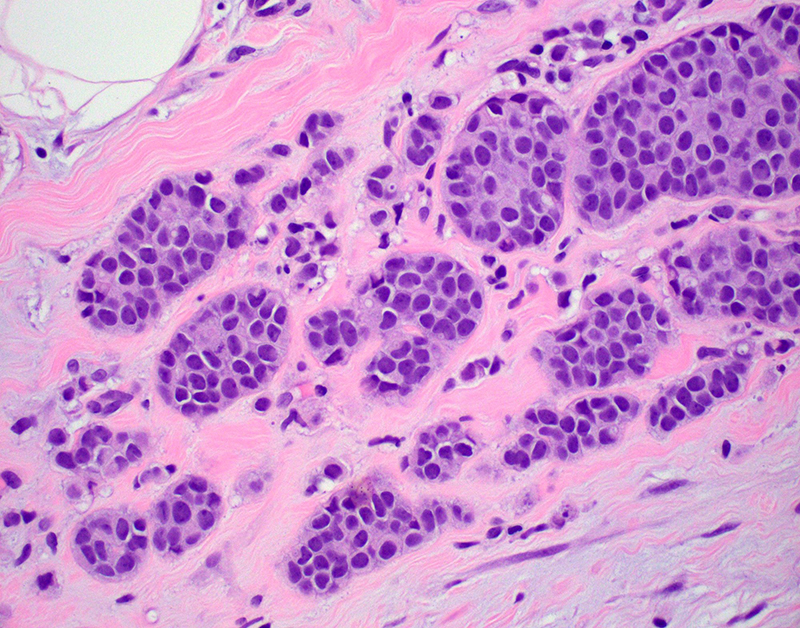 Tăng sản không điển hình của vú là một trong các loại tiền ung thư đặc trưng bởi sự sinh sản bất thường của các tế bào