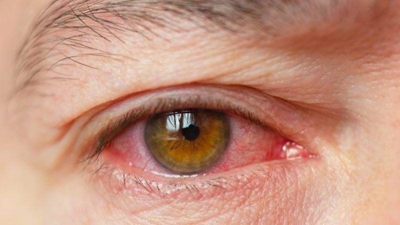 Giác mạc có thể bị tổn thương dẫn đến viêm do tác nhân lạ vào mắt