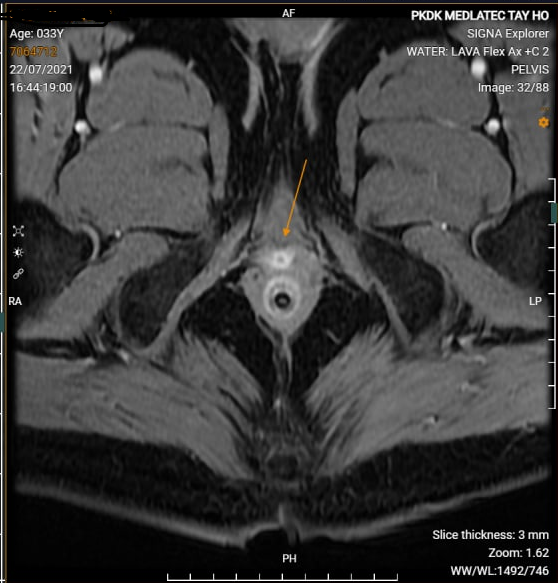 Hình ảnh chụp cộng hưởng từ MRI vùng hậu môn trực tràng tại MEDLATEC
