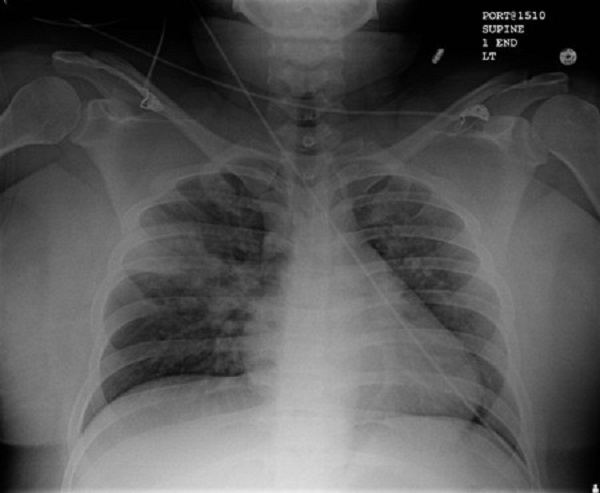 Viêm phổi hít (hay viêm phổi sặc) 