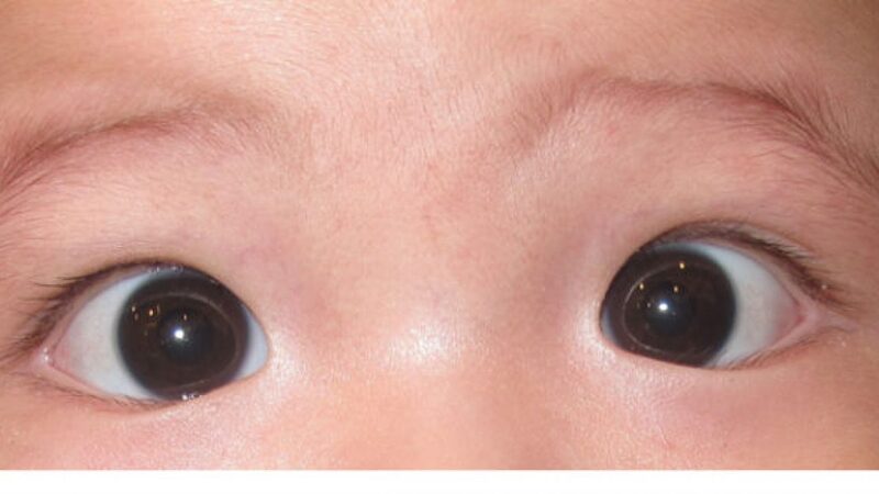 Lác mắt từ nhỏ có phẫu thuật được không