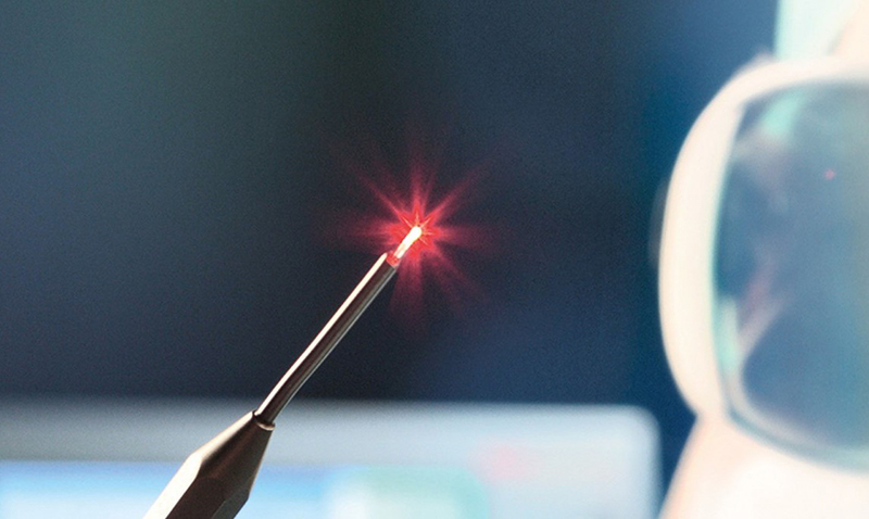 Cắt, loại bỏ trĩ bằng tia laser là phương pháp ít xâm lấn với người bệnh