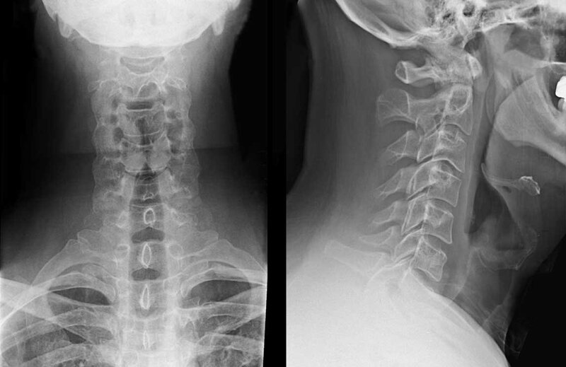 Chẩn đoán đau lưng trên và giữa chủ yếu dựa trên chẩn đoán hình ảnh