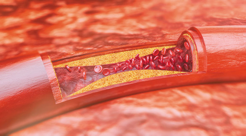 Xơ vữa động mạch gây ra tắc nghẽn mạch máu não