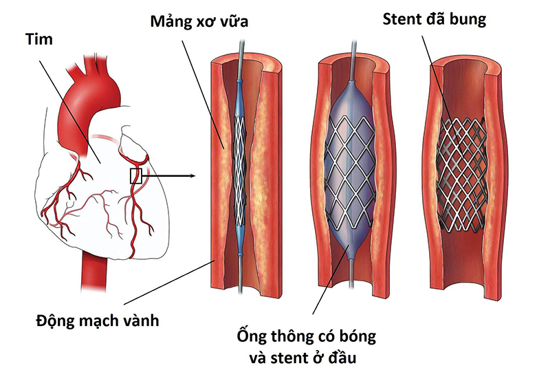 Đặt stent là giải pháp phẫu thuật điều trị động mạch vành
