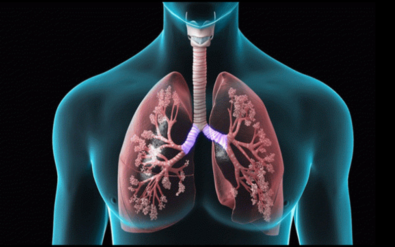 Ghép phổi là biện pháp cuối cùng giúp kéo dài sự sống của bệnh nhân xơ phổi