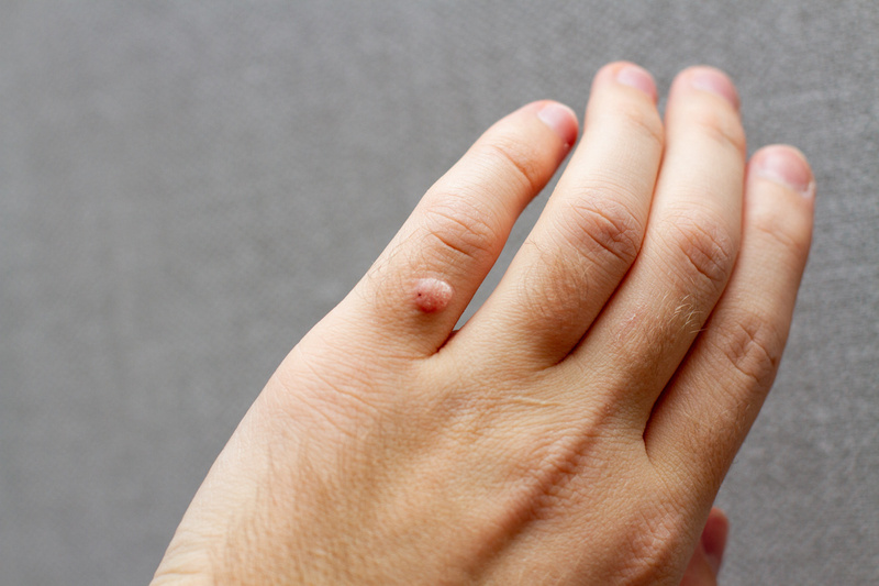 Mụn cóc thường xuất hiện ở tay, chân và gây đau đớn