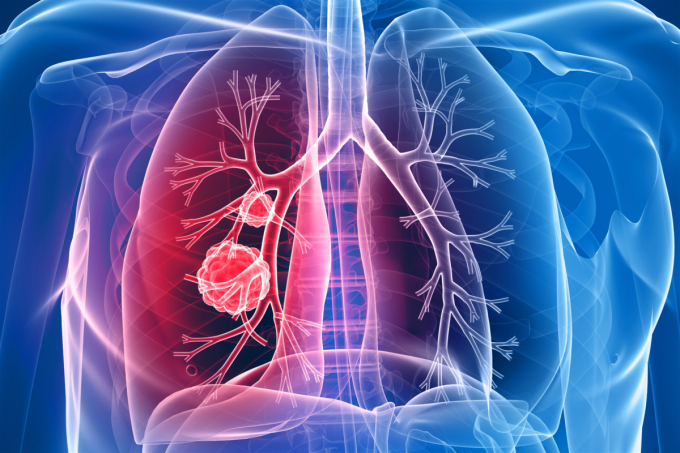 Ung thư phổi nguyên phát trước đây được dùng để đề cập đến những bệnh ung thư phổi xuất phát từ tiểu phế quản và phế quản