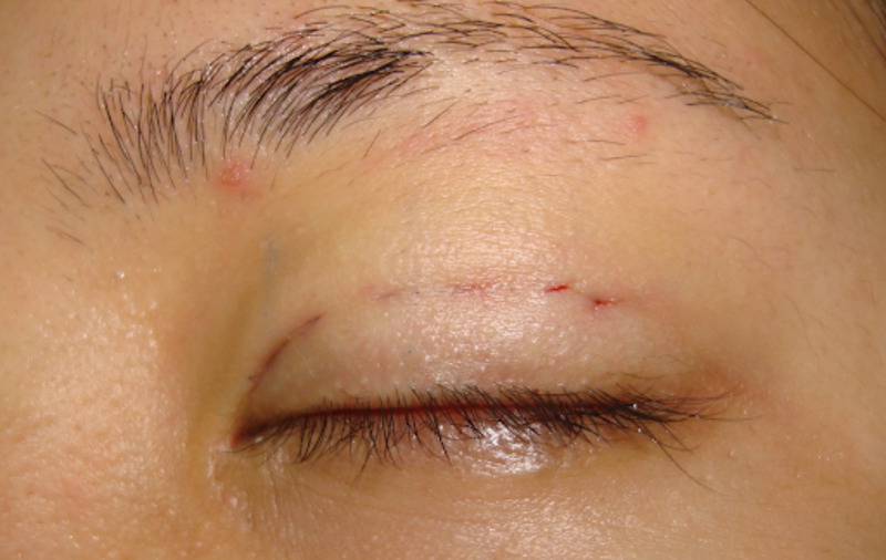 Vùng da sau phẫu thuật lấy mỡ thừa mí mắt sẽ phục hồi sau vài tuần
