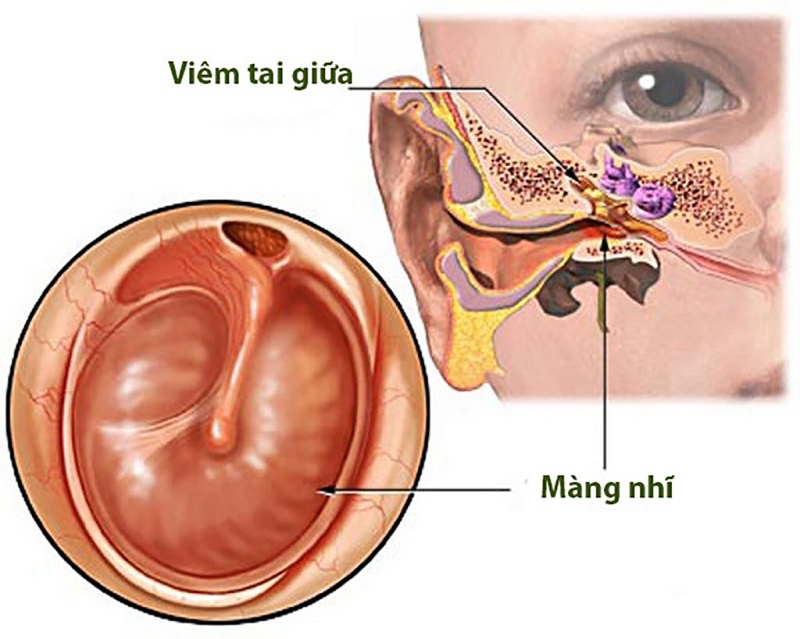 Xử trí khi trẻ bị viêm tai giữa nung mủ không đúng cách có thể gây thủng màng nhĩ