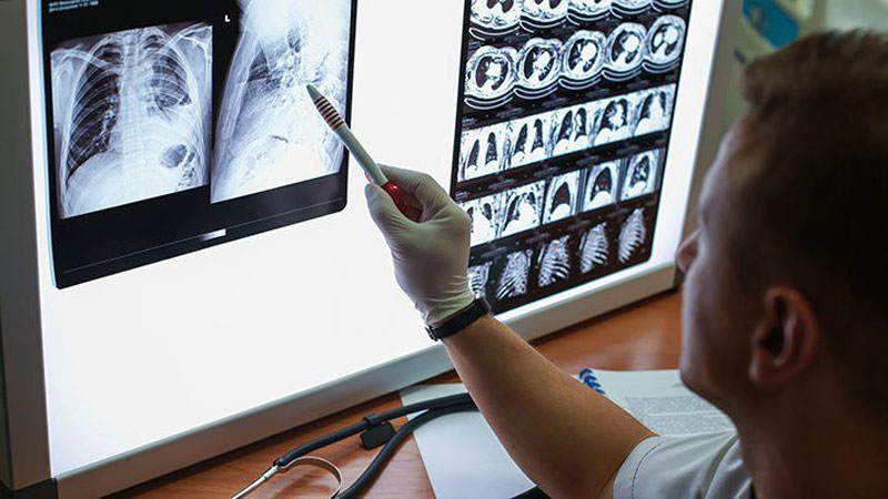 Chụp X-quang ngực để chẩn đoán bệnh chính xác