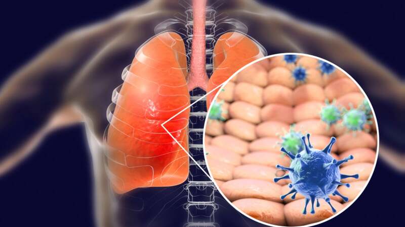  Hội chứng suy hô hấp thực chất là một dạng tổn thương phù phổi