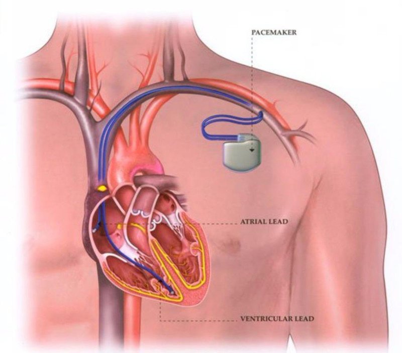 Cấy máy tạo nhịp tim là cần thiết cho bệnh nhân mắc hội chứng QT
