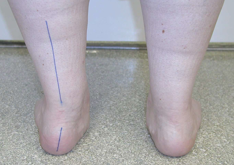  Bàn chân bẹt ở trẻ có thể là do di truyền