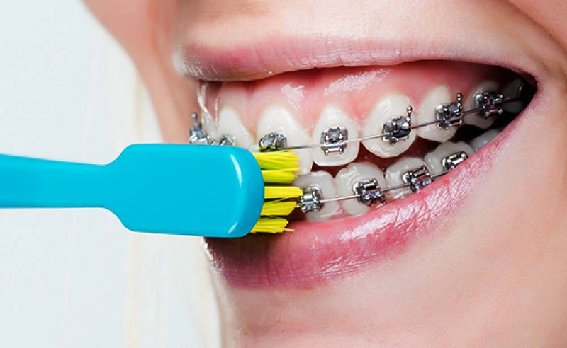 Vệ sinh răng đúng cách giúp răng không bị yếu đi sau khi niềng