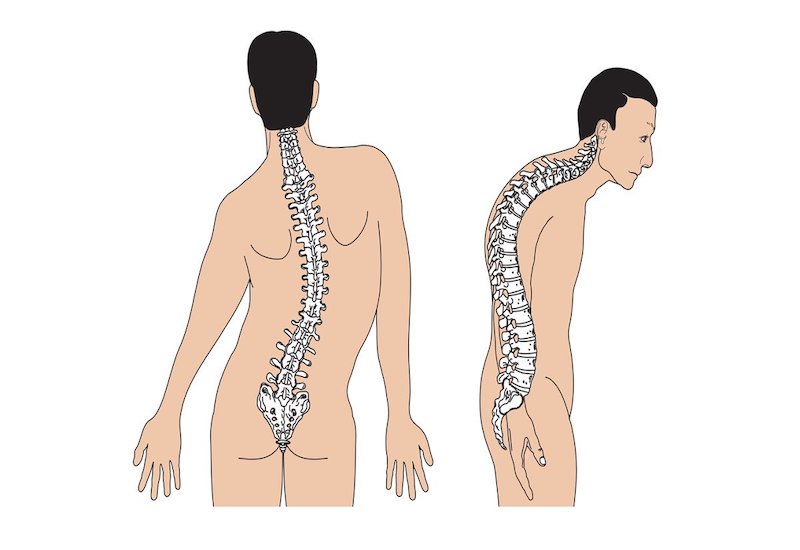 Nền xương kém chắc gây nên hiện tượng gù vẹo lưng