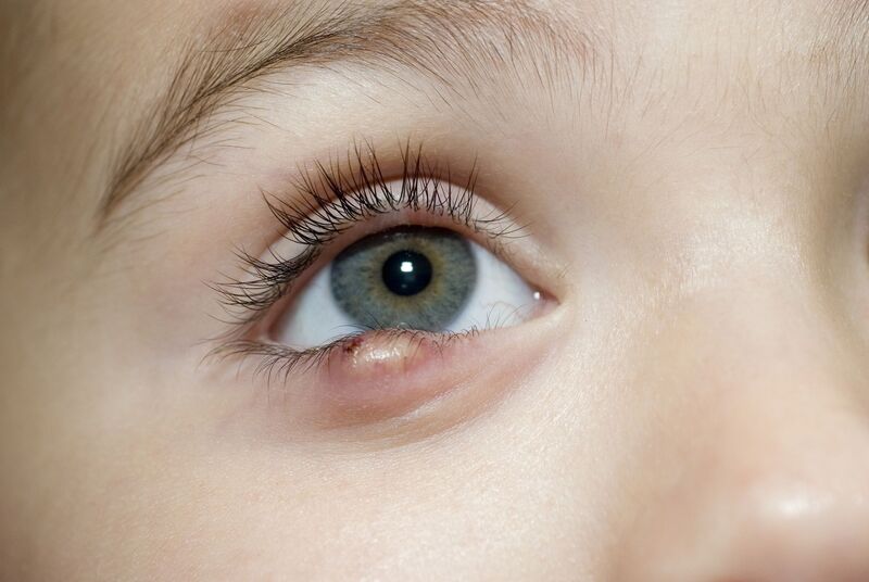 Chắp mắt có thể bội nhiễm nặng
