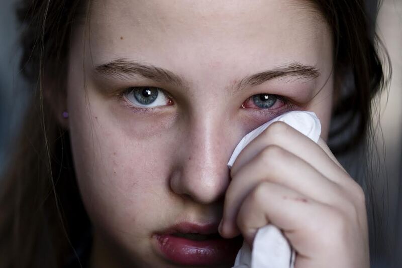 Lệch thủy tinh thể thường xảy ra sau chấn thương mắt