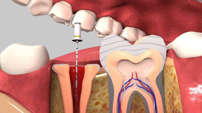 Răng sau điều trị tủy răng cần được bọc bảo vệ