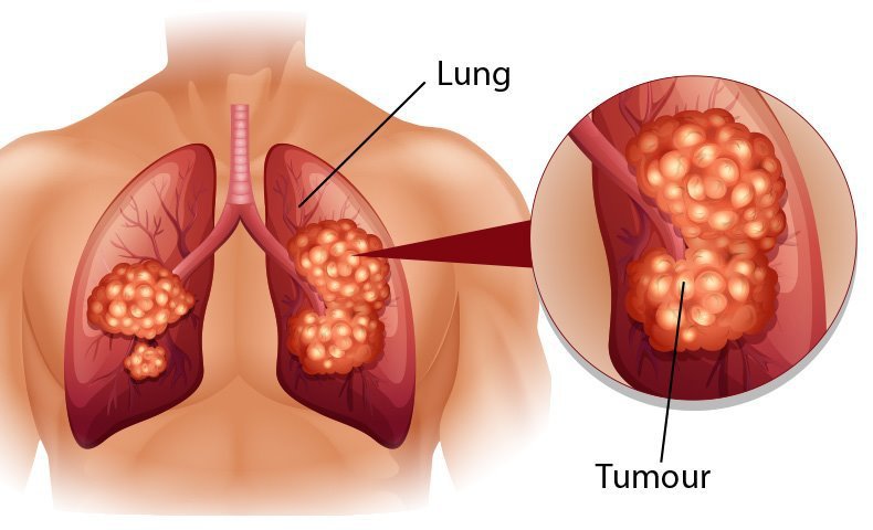 Hình ảnh minh họa ung thư phế quản nguyên phát
