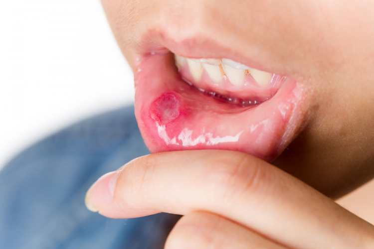Loét aptor miệng là tình trạng viêm loét phổ biến ở niêm mạc mềm của miệng và lợi