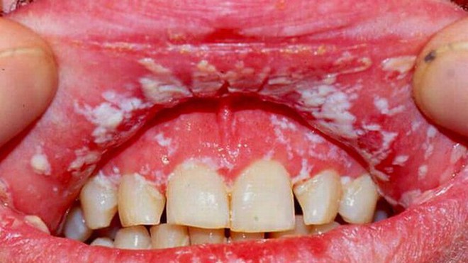 Viêm miệng do nấm là tình trạng nhiễm nấm ở  niêm mạc bao phủ trong khoang miệng