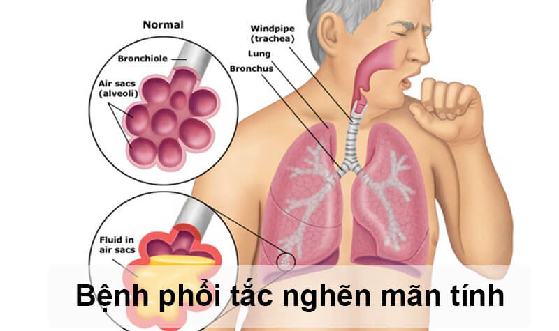 Bệnh phổi tắc nghẽn mạn tính là một căn bệnh phổ biến về phổi