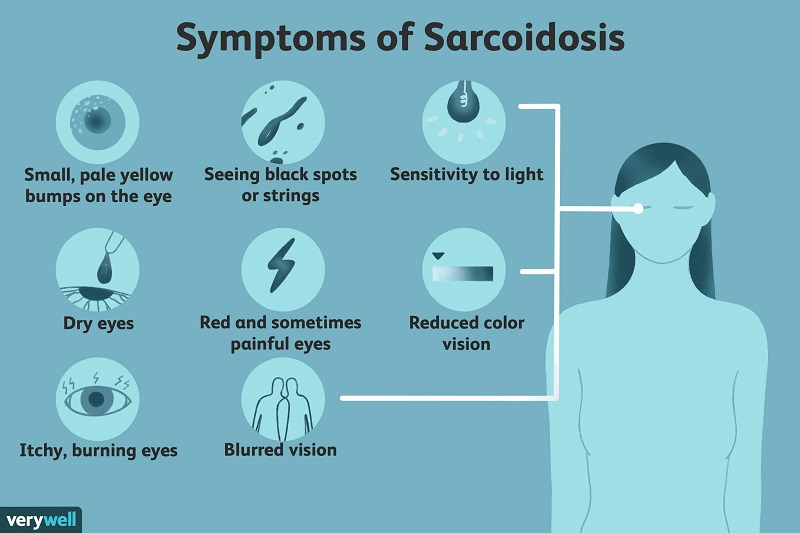 Sarcoidosis là một rối loạn đa hệ thống, căn nguyên chưa được biết rõ, đặc trưng về mặt bệnh lý bởi sự hiện diện của các u hạt không tăng sinh