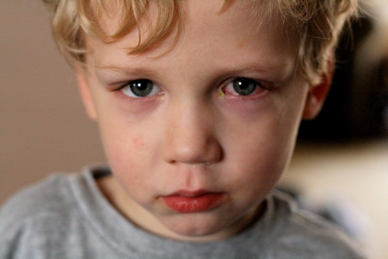 Điều trị sớm giúp trẻ bị lác mắt phục hồi tốt hơn