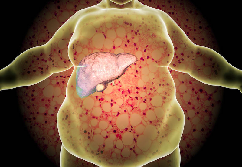 Gan nhiễm mỡ là một trong các nguyên nhân dẫn tới hiện tượng nóng gan