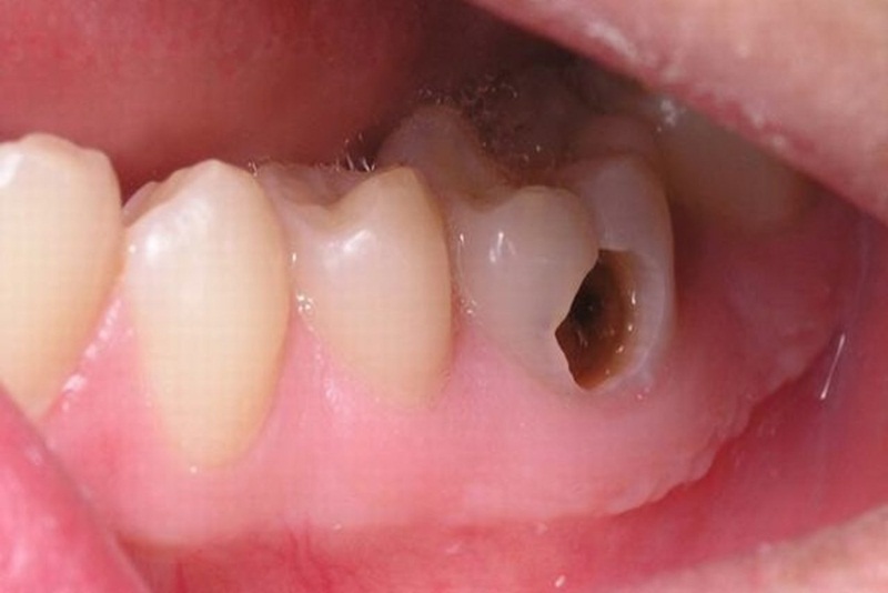 Sâu răng là nguyên nhân gây viêm tủy răng