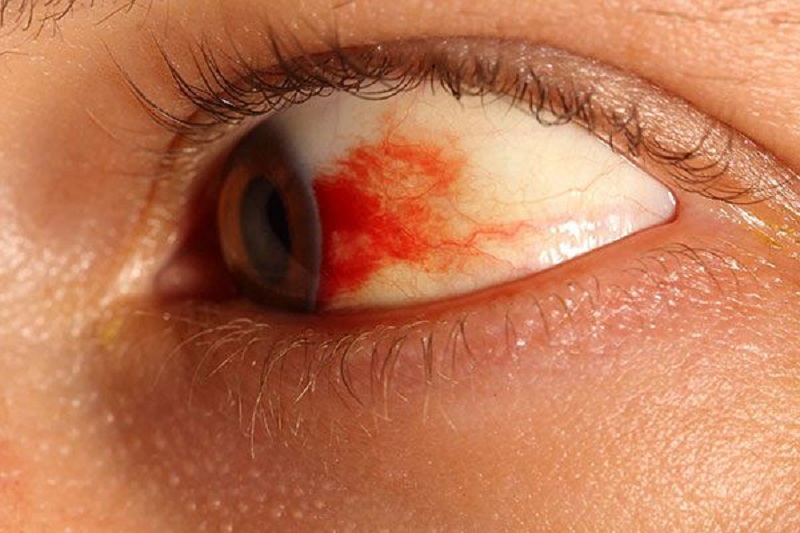 máu bầm ở mắt có nguy hiểm không