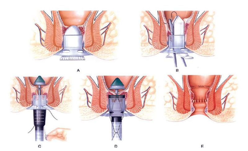 Phẫu thuật trĩ bằng công nghệ Longo là phương pháp điều trị hiệu quả với chi phí thấp