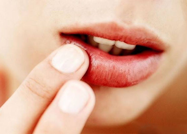 U ác của môi  là một  bệnh lý thuộc nhóm các biểu hiện của căn bệnh ung thư miệng