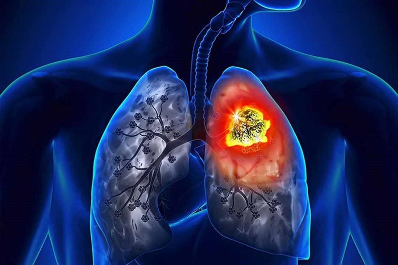 Ung thư phế quản có thể bắt nguồn từ tình trạng di căn ung thư từ các tổ chức bên ngoài phổi hoặc xuất hiện từ trong phổi
