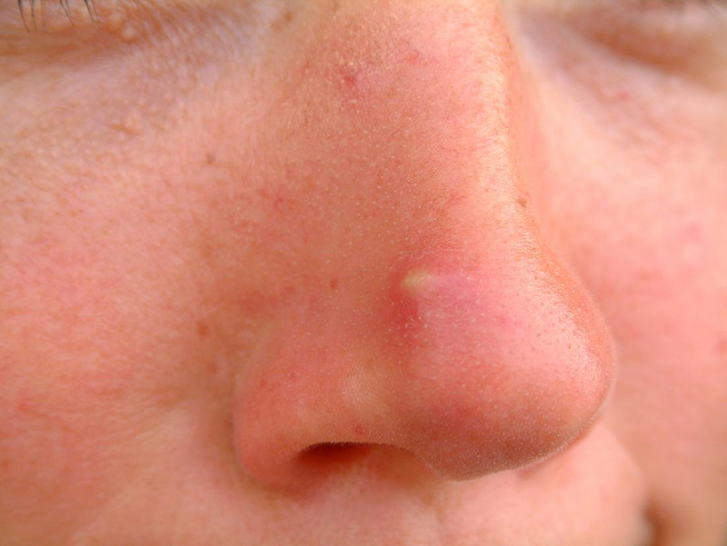 Mụn bọc thường dễ xuất hiện ở vùng mũi hơn những vùng da khác