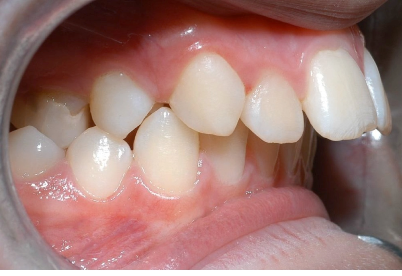 Các loại răng vẩu thường gặp