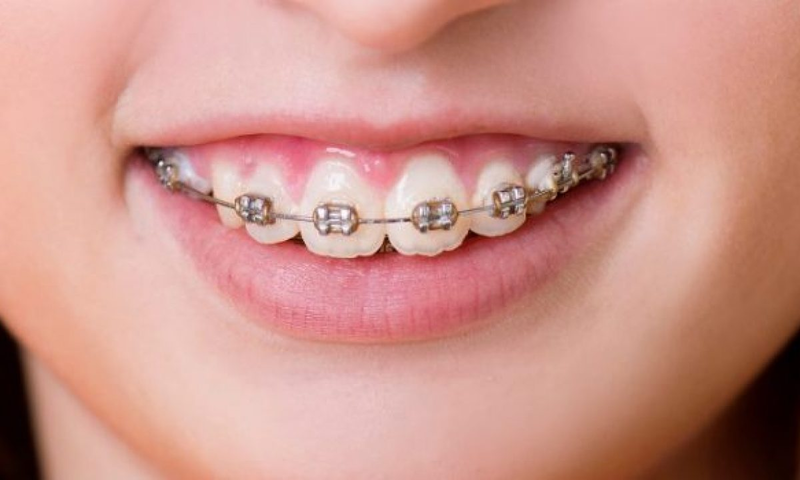 Răng vẩu hở lợi gây cảm giác chiều dài răng ngắn bất thường