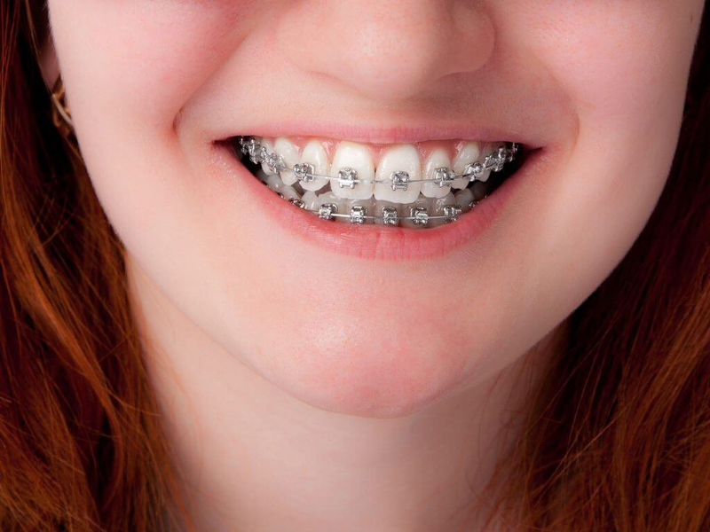 Nếu vẩu do răng có thể niềng để chỉnh lại vị trí răng