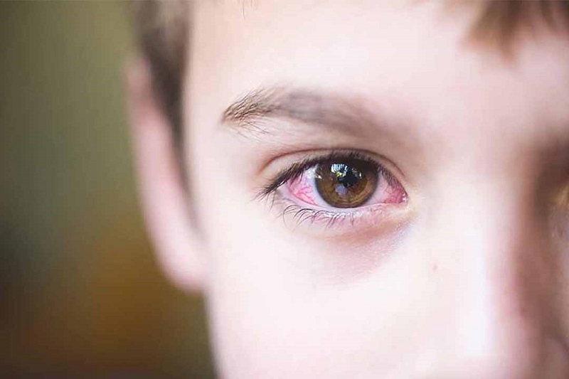 Thiếu vitamin A gây bệnh khô mắt