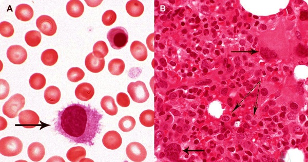 Đa hồng cầu nguyên phát là một bệnh máu ác tính do có sự tăng sinh nhưng không được kiểm soát của các dòng tế bào sinh máu