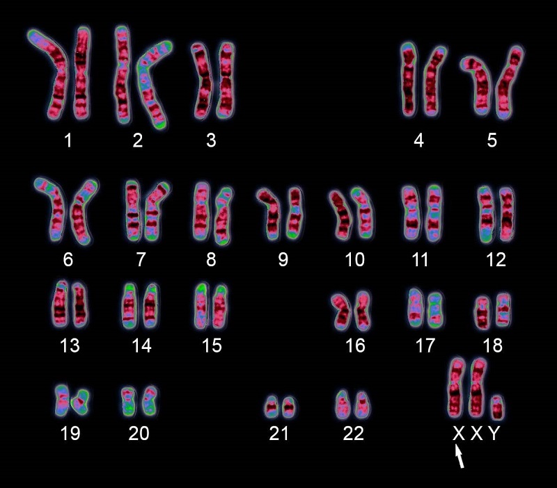 Hội chứng Klinefelter người bệnh có thừa một nhiễm sắc thể giới tính X (47,XXY) thay vì bộ nhiễm sắc thể là 46,XY