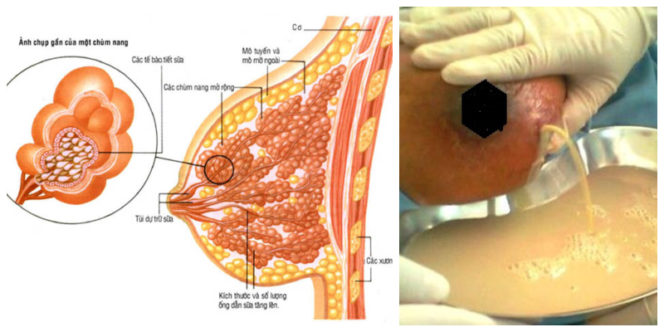 Áp xe vú là ổ chứa đầy mủ, xung quanh là mô viêm, được phát triển từ một ổ viêm ở vú