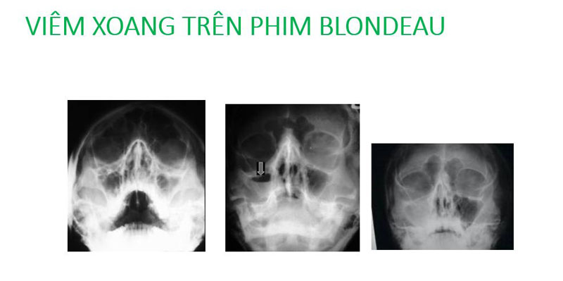 Cách đọc kết quả chụp X-quang viêm xoang Blondeau