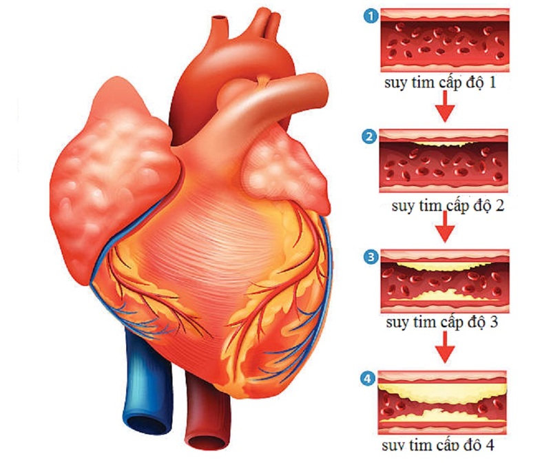 Biến chứng suy tim là một trong những nguyên nhân gây phù phổi cấp