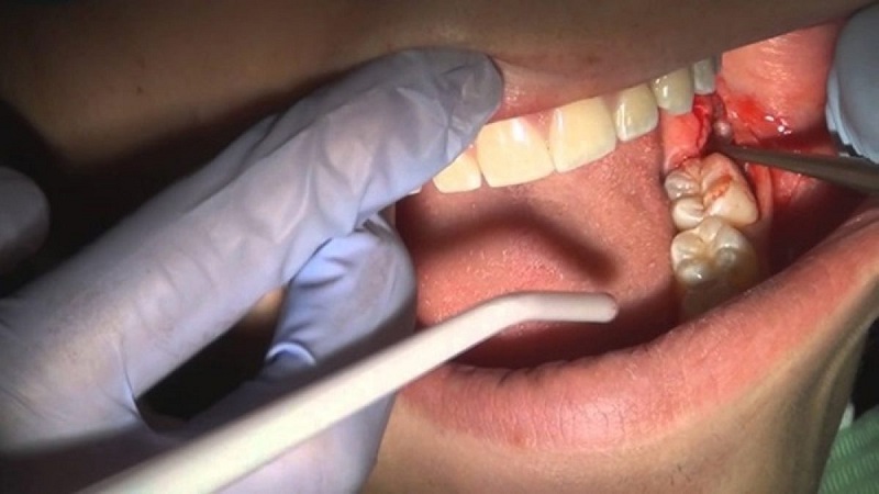 Nhổ răng số 7 nên thực hiện tại cơ sở nha khoa uy tín để không gây ra hệ lụy xấu